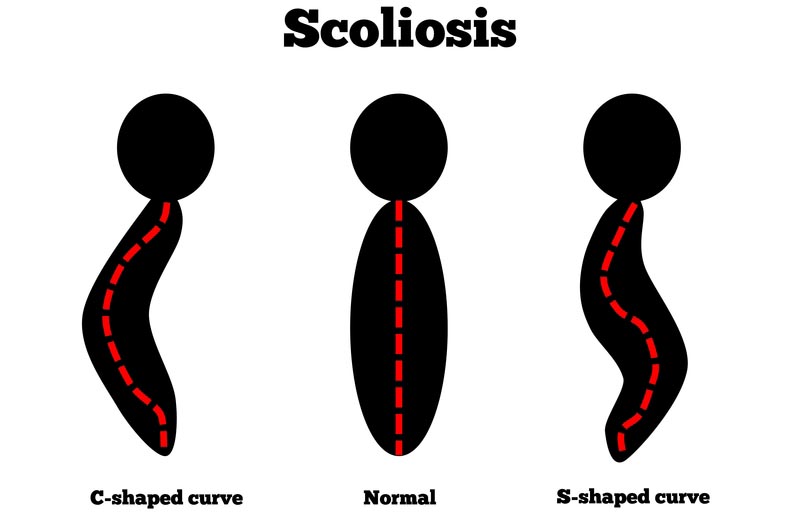 Nashville, TN scoliosis treatment